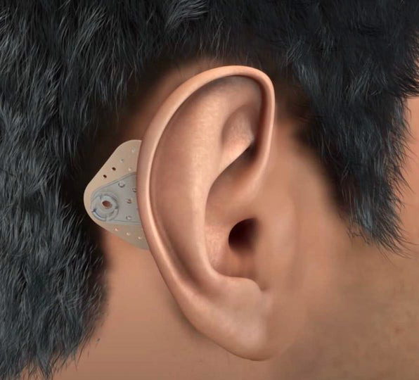 Bone Conduction Implants